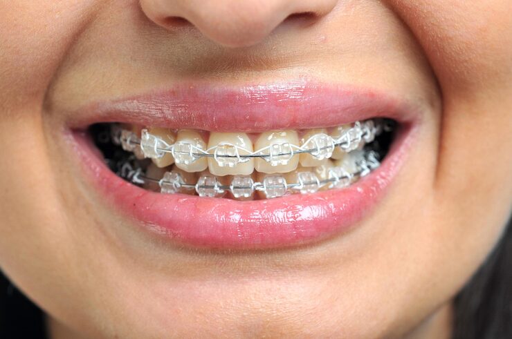 Ceramic Braces Tooth Coloured Braces